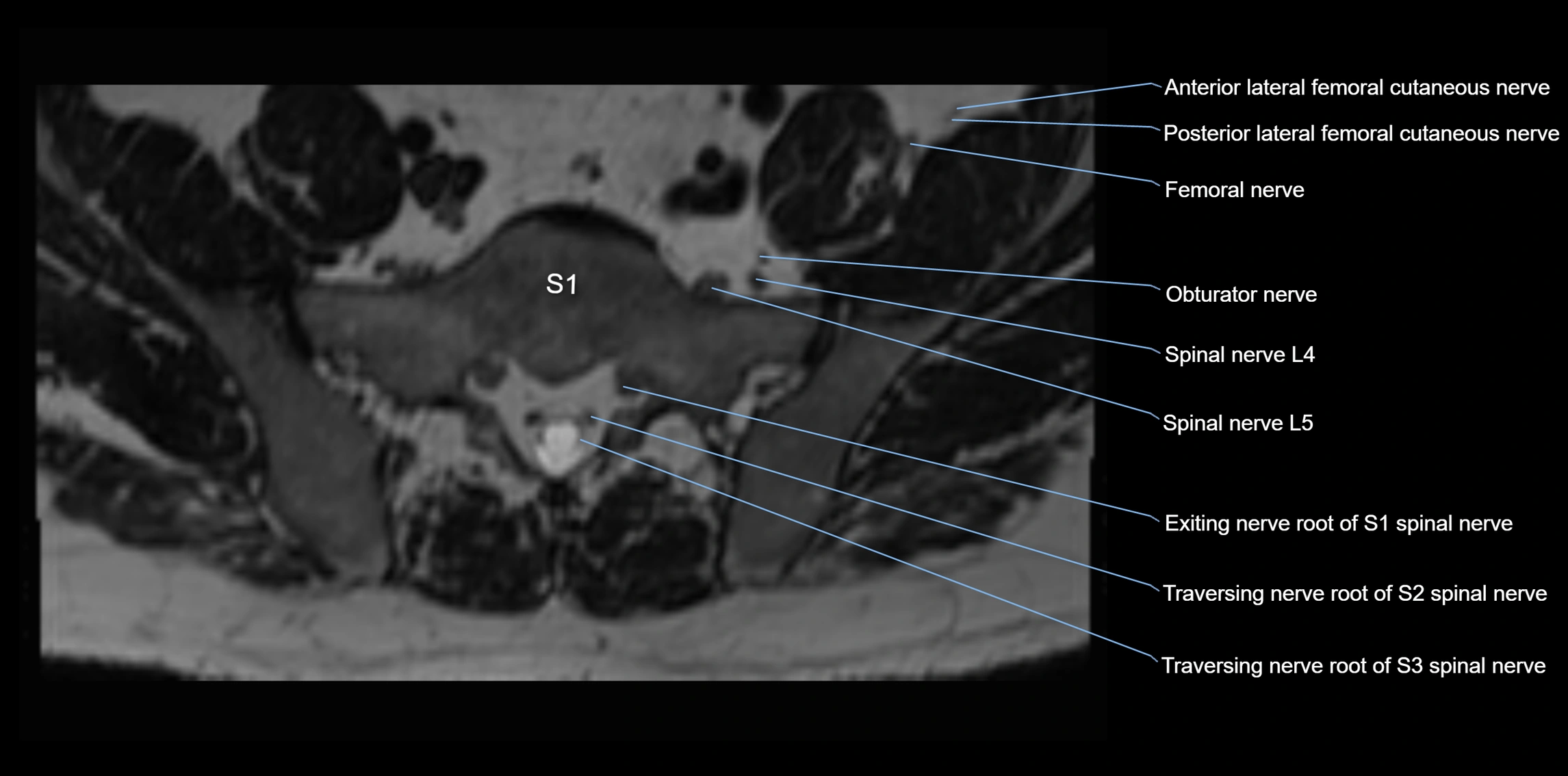 MR lumbosacral plexus axial cross sectional anatomy 3T  radiology  image-img-1008001-00071.webp